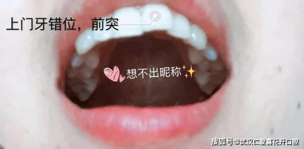 武漢仁愛口腔:小姐姐歷經3次矯正終于成功,整牙避坑干貨必看!