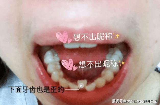 武漢仁愛口腔:小姐姐歷經3次矯正終于成功,整牙避坑干貨必看!