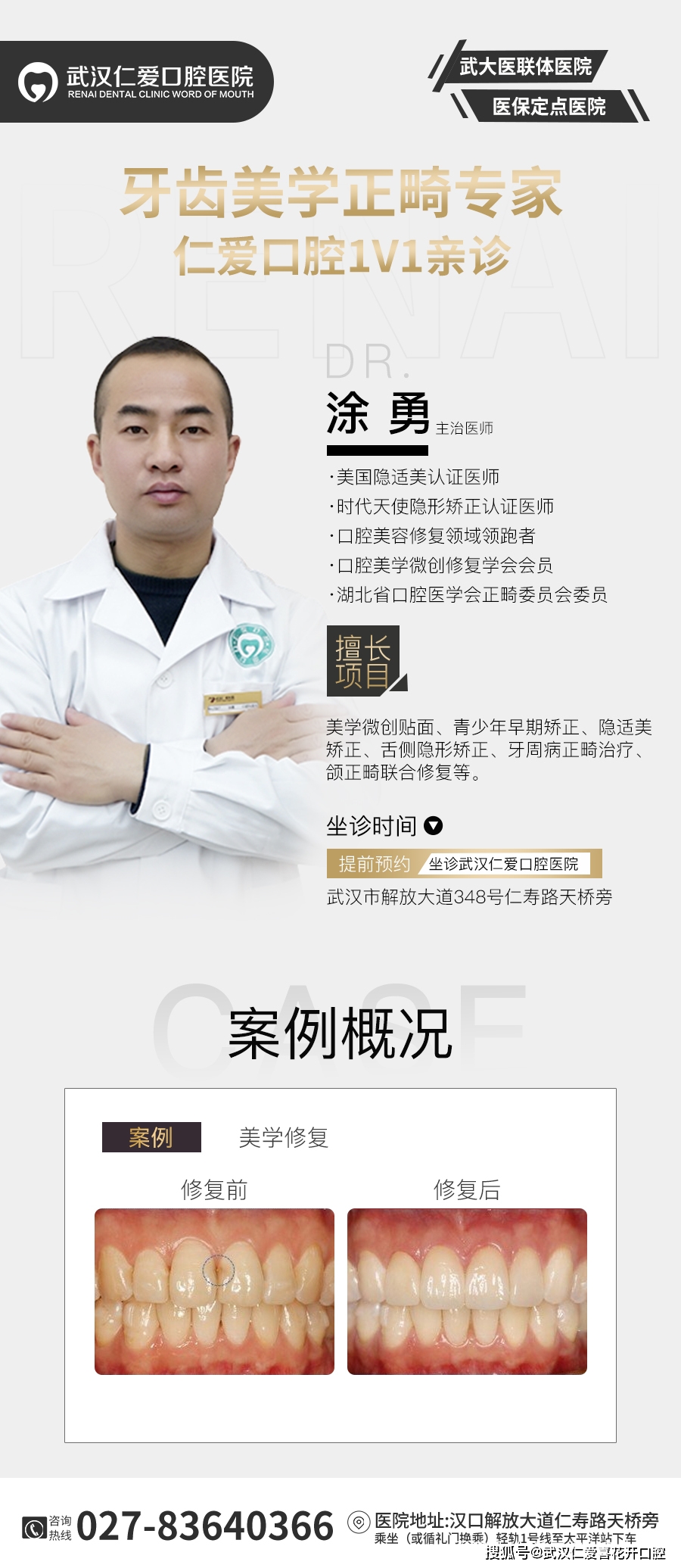 武漢仁愛(ài)口腔 數(shù)字化即刻美學(xué)貼面案例分享