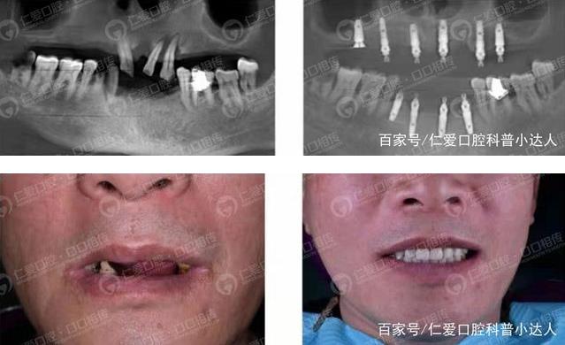 武漢種牙上午滿口無牙 下午吃嘛嘛香,讓缺牙患者瞬間擁有好口福!