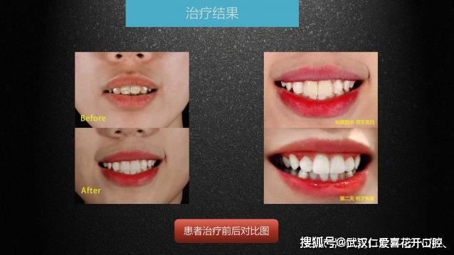 武漢仁愛(ài)口腔 數(shù)字化即刻美學(xué)貼面案例分享