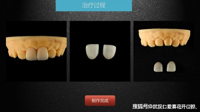 武漢仁愛(ài)口腔 數(shù)字化即刻美學(xué)貼面案例分享