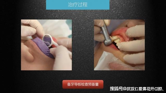 武漢仁愛(ài)口腔 數(shù)字化即刻美學(xué)貼面案例分享