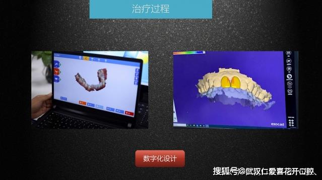 武漢仁愛(ài)口腔 數(shù)字化即刻美學(xué)貼面案例分享
