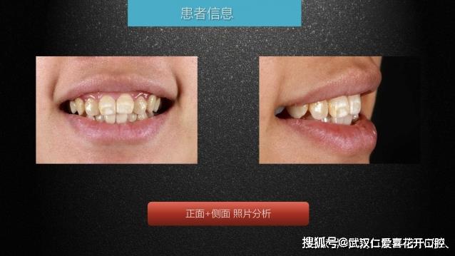 武漢仁愛(ài)口腔 數(shù)字化即刻美學(xué)貼面案例分享