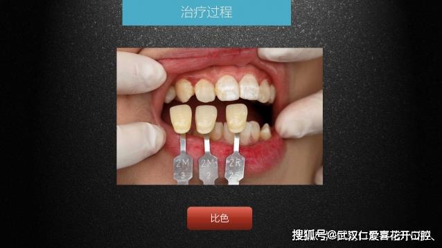武漢仁愛(ài)口腔 數(shù)字化即刻美學(xué)貼面案例分享