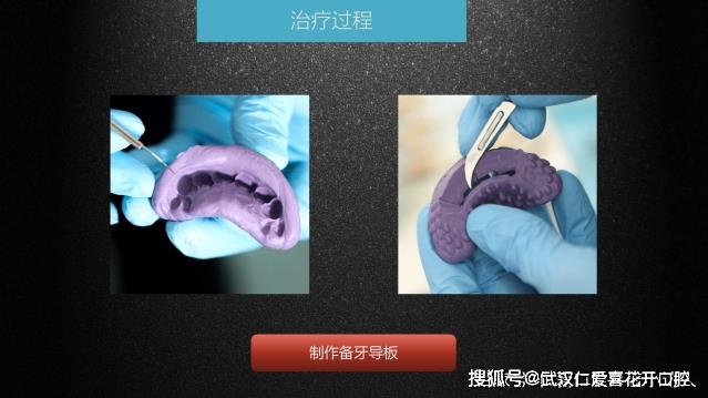 武漢仁愛(ài)口腔 數(shù)字化即刻美學(xué)貼面案例分享