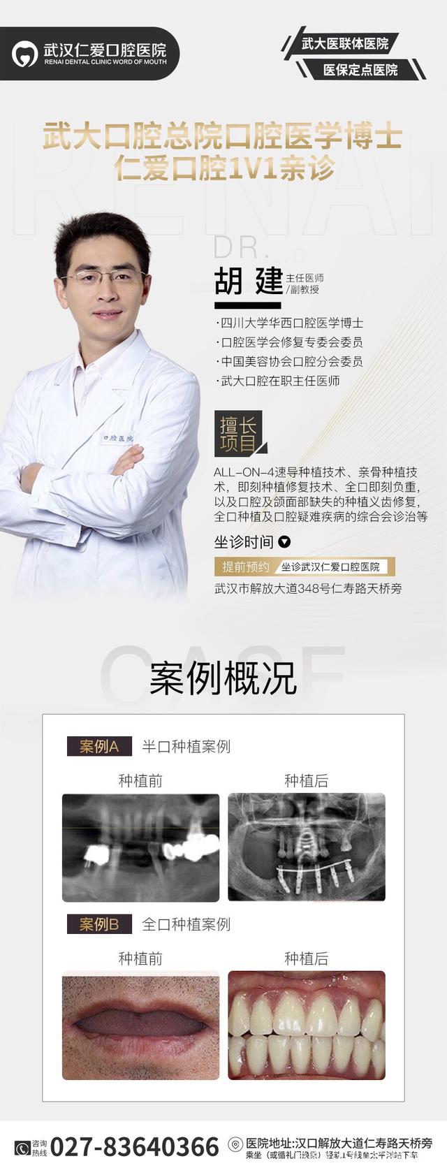 武漢種牙上午滿口無牙 下午吃嘛嘛香,讓缺牙患者瞬間擁有好口福!