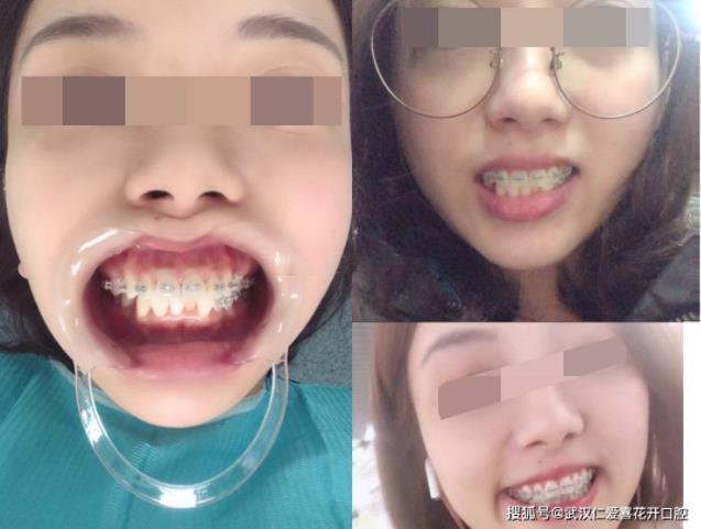 武漢仁愛口腔牙齒矯正案例分享 ▏用“牙套”換一個更美的自己!
