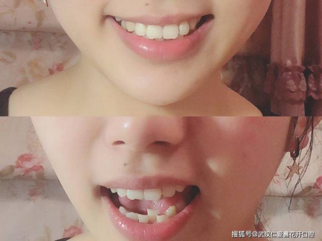 武漢仁愛口腔牙齒矯正案例分享 ▏用“牙套”換一個更美的自己!