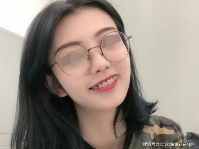 武漢仁愛口腔牙齒矯正案例分享 ▏用“牙套”換一個更美的自己!
