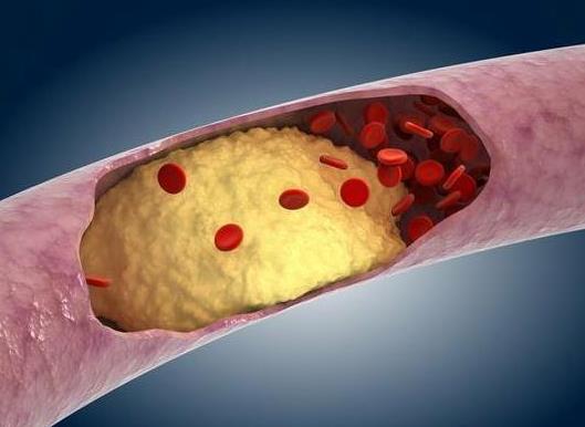 急性胰腺炎治愈后能一生不復發嗎?急性胰腺炎怎么治療?
