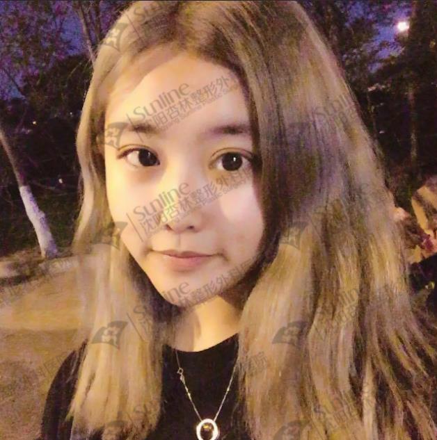 沈陽(yáng)雙眼皮前后對(duì)比,雙眼皮真人實(shí)拍案例