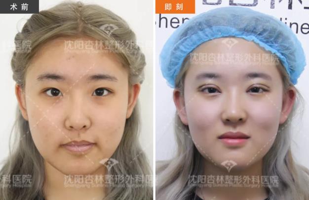 沈陽(yáng)雙眼皮前后對(duì)比,雙眼皮真人實(shí)拍案例