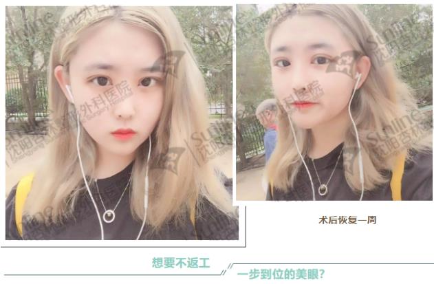 沈陽(yáng)雙眼皮前后對(duì)比,雙眼皮真人實(shí)拍案例