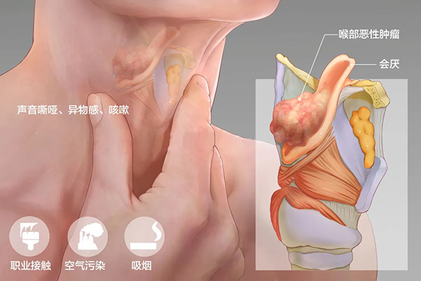 成都民生耳鼻喉醫院科普 聲音嘶啞是什么病