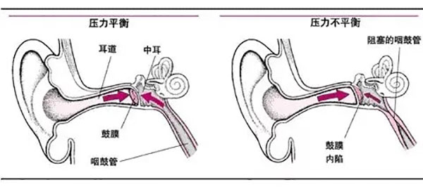 為什么感冒容易引起中耳炎?這些知識點你得了解!