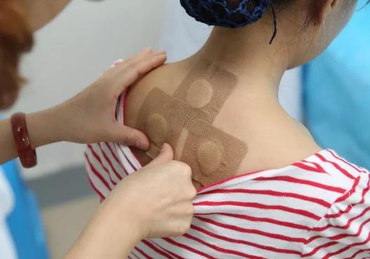貼三伏貼后多久可以同房?三伏貼和艾灸一起做好不好