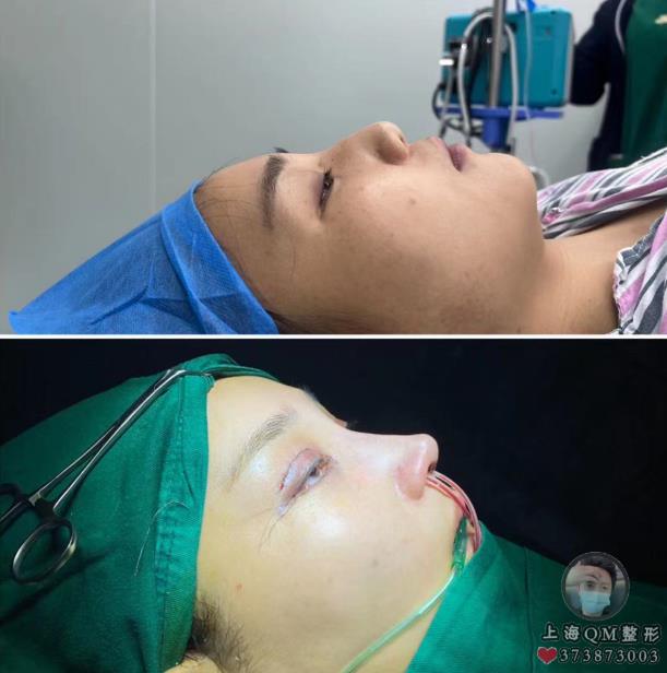 上海徐麗芬整形醫(yī)生關(guān)于整形肋骨鼻的相關(guān)問答
