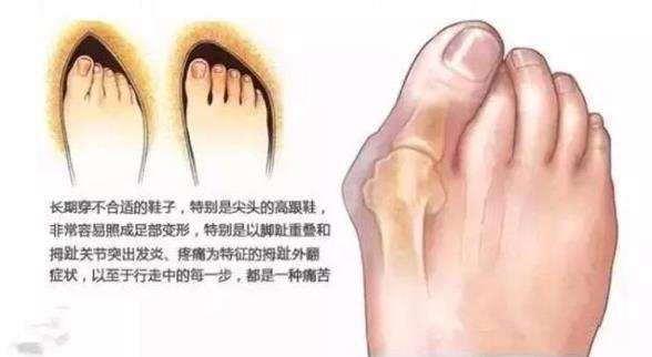 上海健橋醫院拇外翻侯明主任:腳骨拐突出手術多少錢