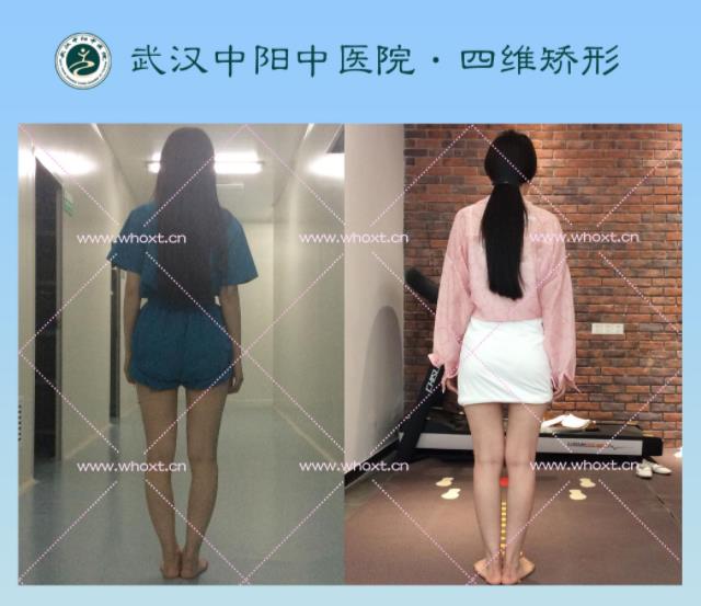 綁腿可以矯正O型腿嗎?武漢中陽醫院四維矯形技術七天矯正腿型異常