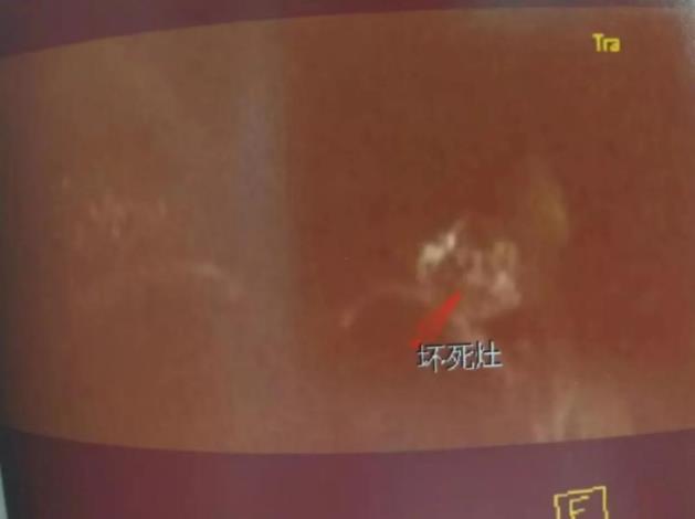 襄樊腫瘤醫院請選擇廣州復大醫院:冷凍治療保住乳腺癌患者的乳房