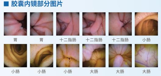 呼和浩特市東大肛腸醫(yī)院 胃里為什么會長息肉?日常如何預(yù)防胃息肉