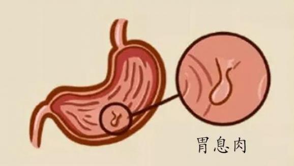 呼和浩特市東大肛腸醫(yī)院 胃里為什么會長息肉?日常如何預(yù)防胃息肉