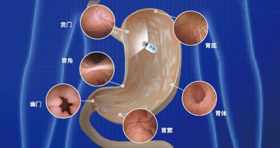 呼和浩特市東大肛腸醫(yī)院 胃里為什么會長息肉?日常如何預(yù)防胃息肉