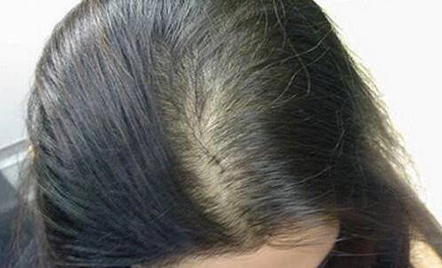 親身經(jīng)歷分享:折磨我4年的產(chǎn)后脫發(fā),被穴位生發(fā)方治愈