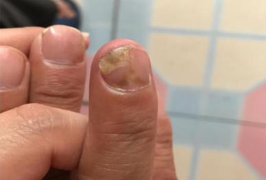 灰指甲什么藥最有效?