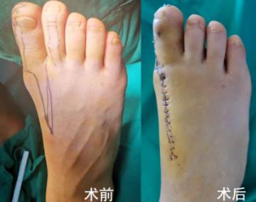 順德和平醫(yī)院靠譜嗎?廣西吉他手 順德再造斷指