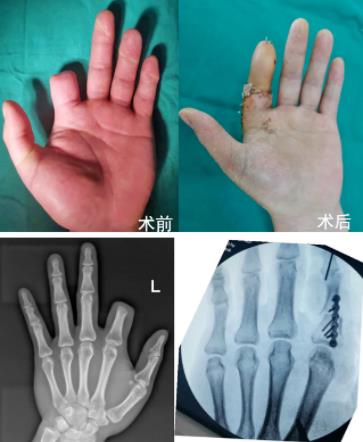 順德和平醫(yī)院靠譜嗎?廣西吉他手 順德再造斷指