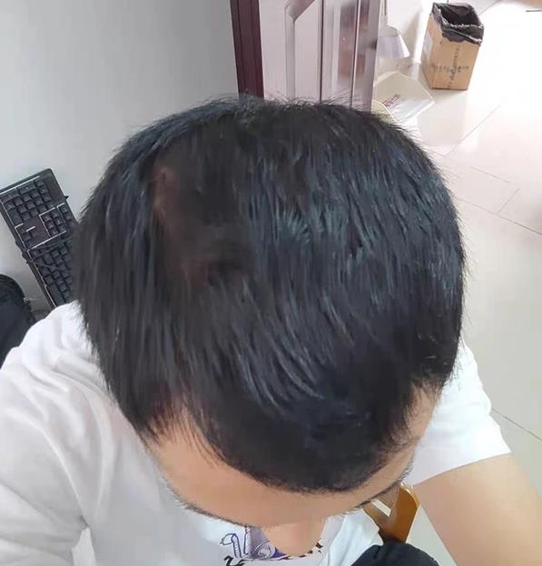 治療脫發|米諾地爾為什么能治療脫發?