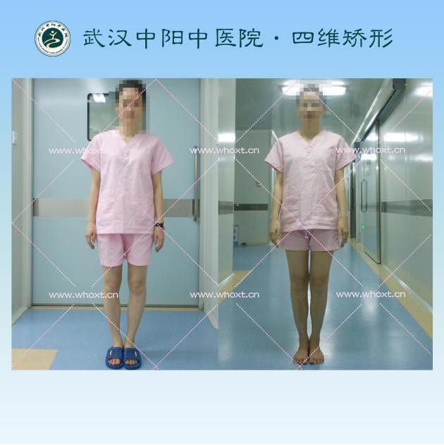 O型腿如何矯正?武漢中陽中醫院四維矯形技術七天無痕矯正腿型