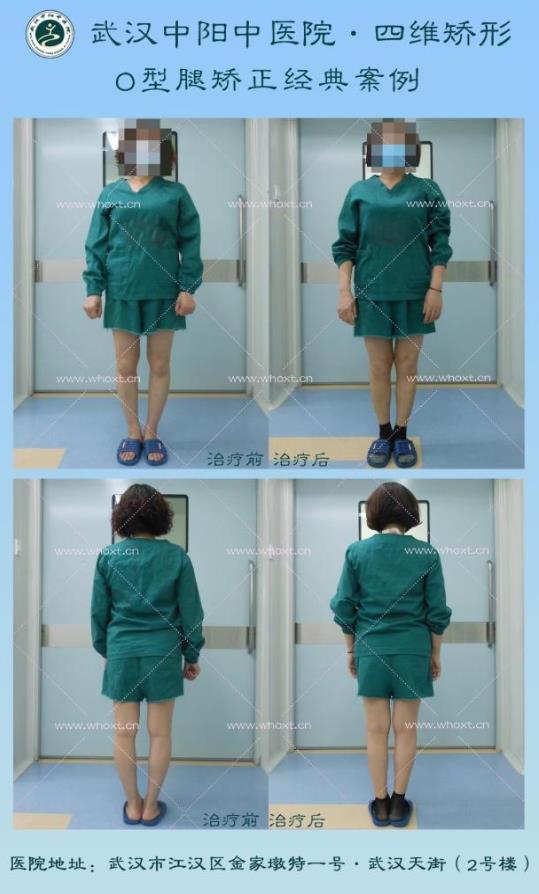 O型腿如何矯正?武漢中陽中醫院四維矯形技術七天無痕矯正腿型