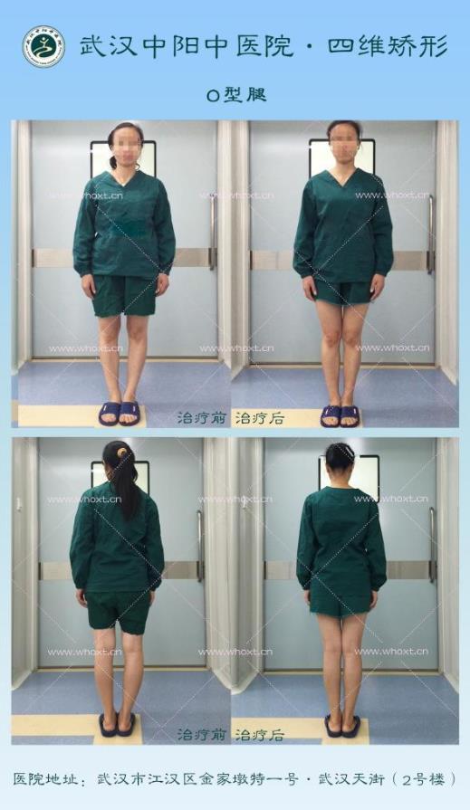 O型腿如何矯正?武漢中陽中醫院四維矯形技術七天無痕矯正腿型
