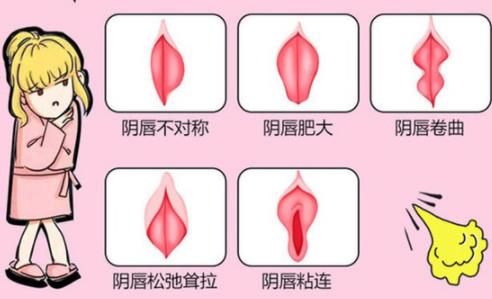 重慶哪家可以做陰唇整形手術?