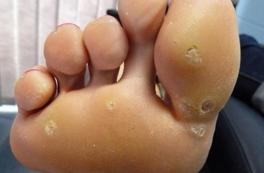 雞眼是長什么樣子的圖片 雞眼是怎么形成的如何鑒別 如何判斷是不是雞眼:雞眼是什么長什么樣子圖片