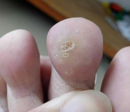 雞眼是長什么樣子的圖片 雞眼是怎么形成的如何鑒別 如何判斷是不是雞眼:雞眼是什么長什么樣子圖片