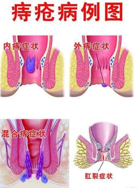 痔瘡病例圖