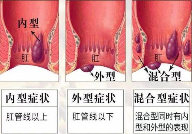 痔瘡圖片