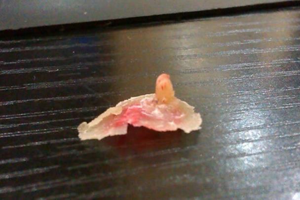 雞眼的癥狀圖片長(zhǎng)什么樣子位置 雞眼挖出來(lái)的根部肉刺圖片