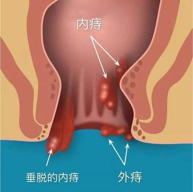 痔瘡長什么樣子在哪個位置圖片 內痔外痔混合痔肉球脫出癥狀對照圖片
