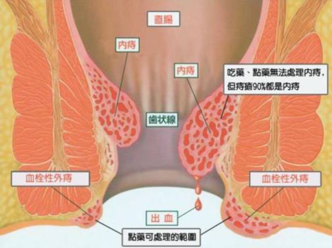 痔瘡長什么樣子在哪個位置圖片 內痔外痔混合痔肉球脫出癥狀對照圖片