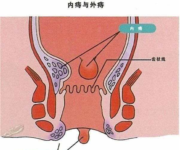 痔瘡長什么樣子在哪個位置圖片 內痔外痔混合痔肉球脫出癥狀對照圖片