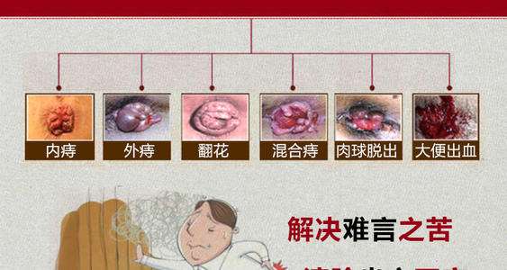 痔瘡長什么樣子在哪個位置圖片 內痔外痔混合痔肉球脫出癥狀對照圖片
