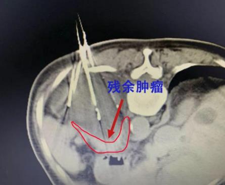 廣州復大腫瘤醫院評價好嗎 診療服務評價有保障