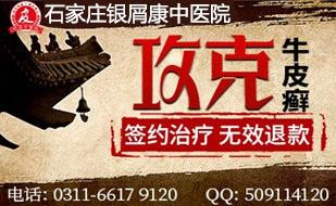 石家莊銀屑康皮膚病中醫院 頭皮牛皮癬癥狀會消失嗎