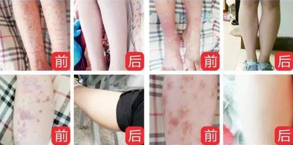 過敏性紫癜怎么治?【成都西南中醫醫院紫癜治療方法對比】